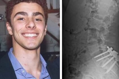 Luigi Mangione News: X-ray of Luigi Mangione's 'stapled spine' viral: 'I'd kill someone too if...'