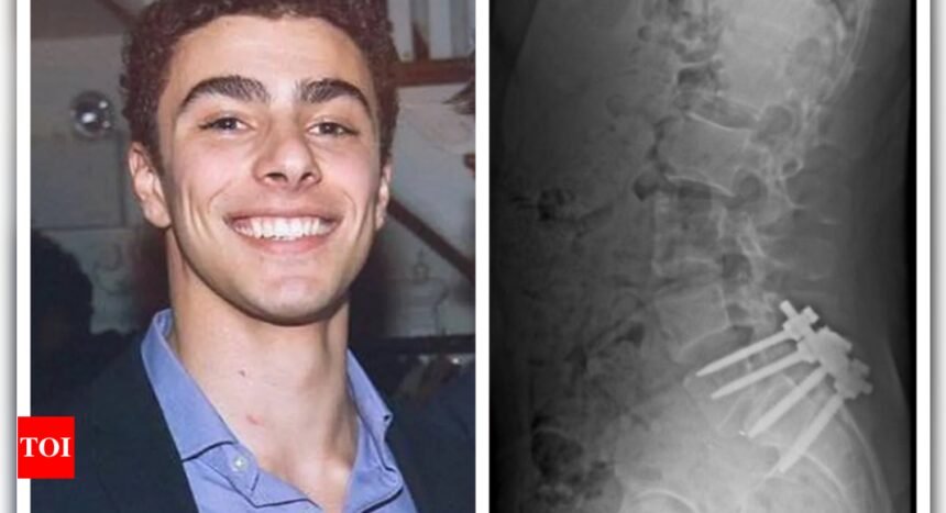 Luigi Mangione News: X-ray of Luigi Mangione's 'stapled spine' viral: 'I'd kill someone too if...'